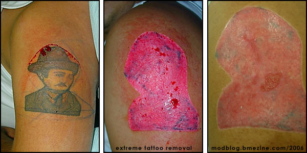 Check out this pretty extreme tattoo removal left to right just getting 
