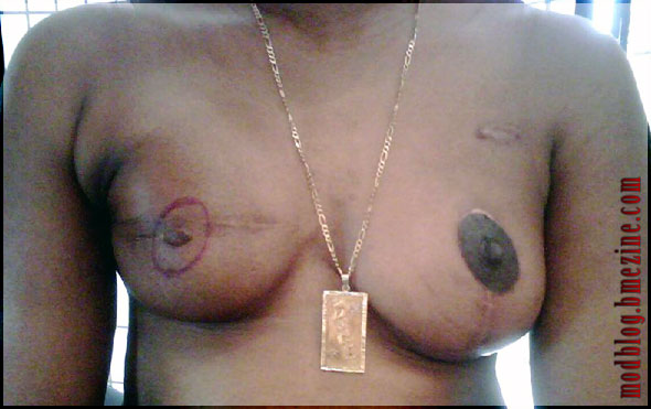 Before - Tattooed Nipple Reconstruction