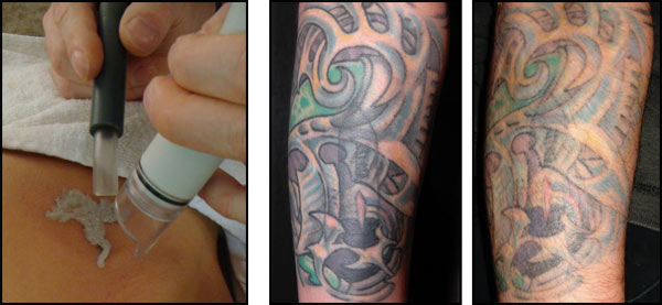 Left in progress Right before and after two sessions