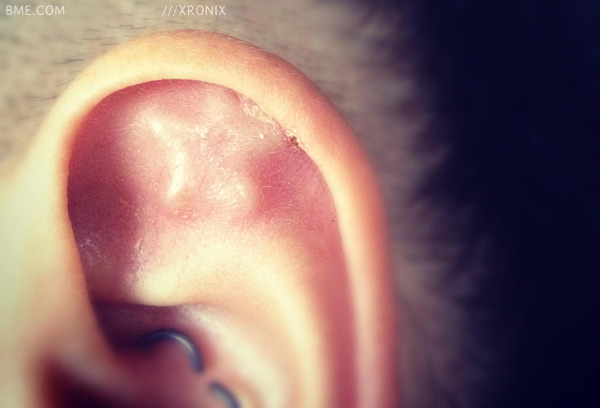 ear-implant-xronix