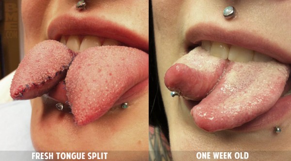 tongue-split-healing